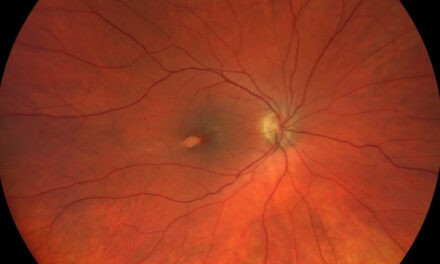 Torpedo Maculopathy