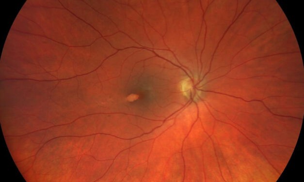 Torpedo Maculopathy
