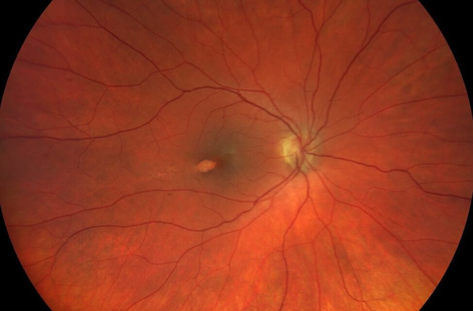 Torpedo Maculopathy