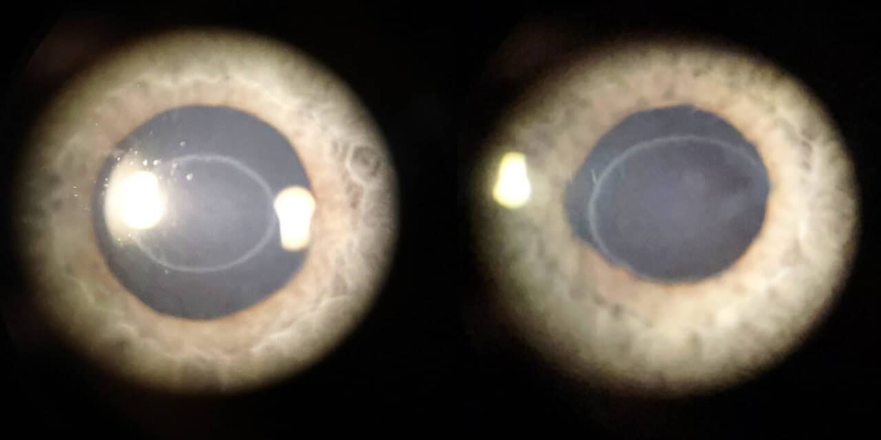 Bilateral Idiopathic Corneal Ring Opacity (Ascher Ring)