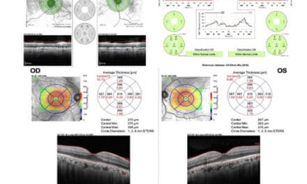 Importance of Ancillary Testing for Voriconazole-Induced Short Term Transient Visual Disturbances