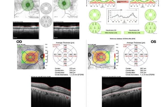 Importance of Ancillary Testing for Voriconazole-Induced Short Term Transient Visual Disturbances