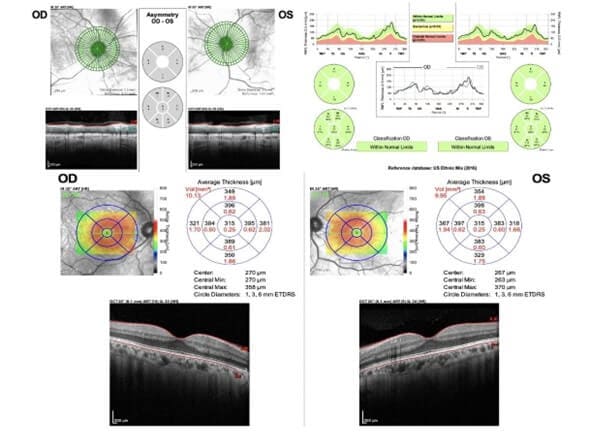 Importance of Ancillary Testing for Voriconazole-Induced Short Term Transient Visual Disturbances