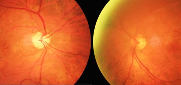 The Phenomenon of Quiescent Tomographically-Detected Macular Neovascularization
