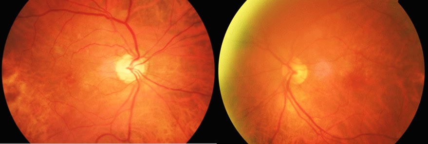 The Phenomenon of Quiescent Tomographically-Detected Macular Neovascularization