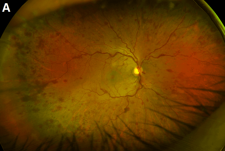 Hyperviscosity-Related Retinopathy and Serous Macular Detachment in Waldenstrӧm Macroglobulinemia Managed With Zanubrutinib