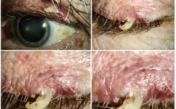 PHOTO ESSAY: Just A Cutaneous Horn or Squamous Cell Carcinoma?