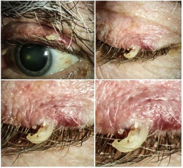 PHOTO ESSAY: Just A Cutaneous Horn or Squamous Cell Carcinoma?