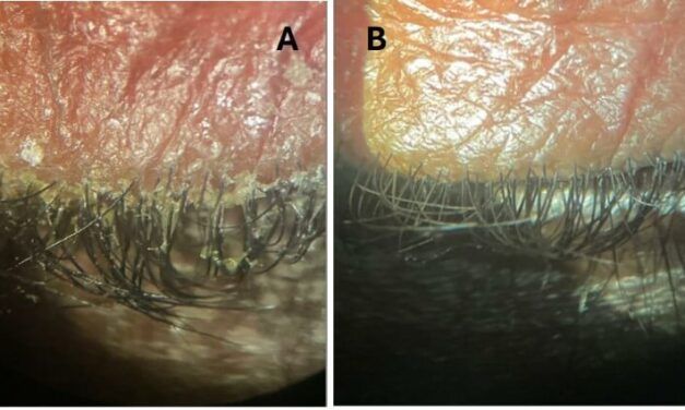 Traditional and Novel Treatment of Demodex Blepharitis