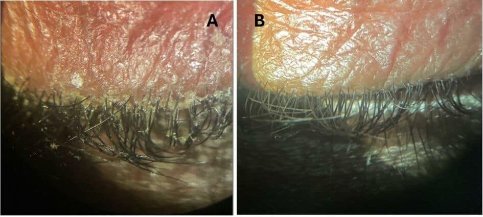 Traditional and Novel Treatment of Demodex Blepharitis