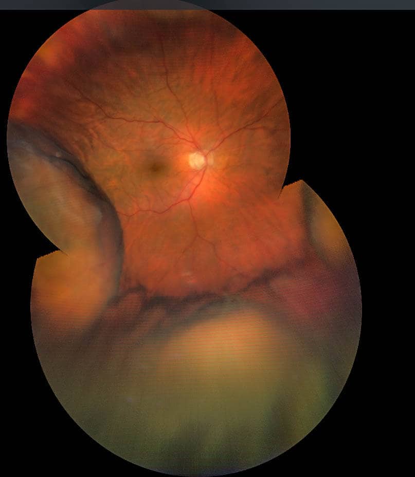 figure 1a hypotony