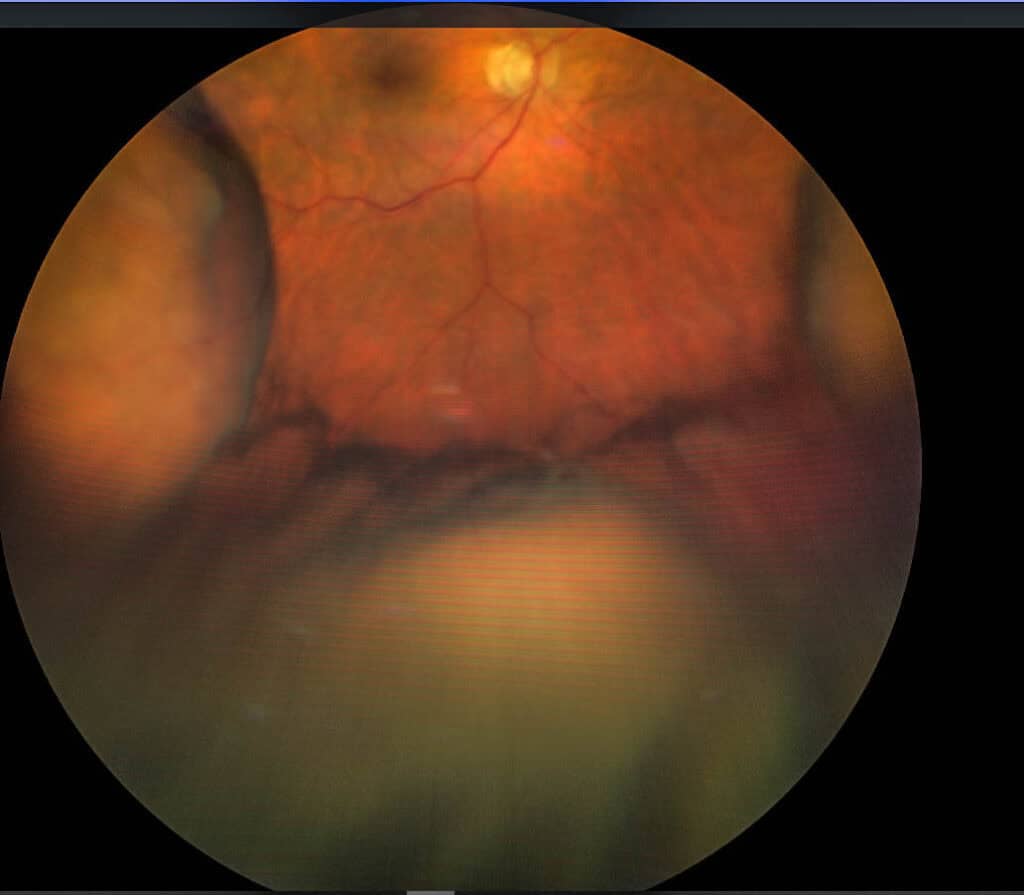 figure 1c hypotony
