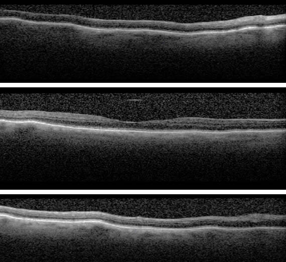 figure 2 hypotony