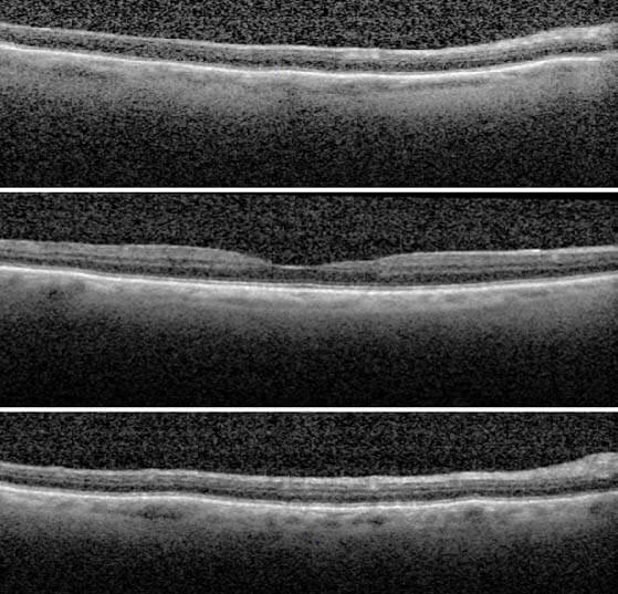 figure 4 hypotony