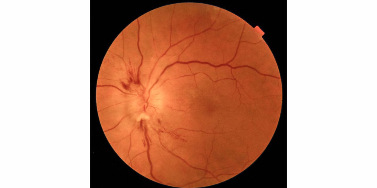 Overtreated Hypertension Results in Sequential Nonarteritic Ischemic Optic Neuropathy