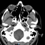PHOTO ESSAY: Management of Penetrating Injuries and Intraocular Foreign Bodies