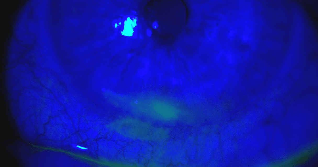A Case of Paralytic Lagophthalmos Following Melanoma Surgery Induced Seventh Nerve Palsy