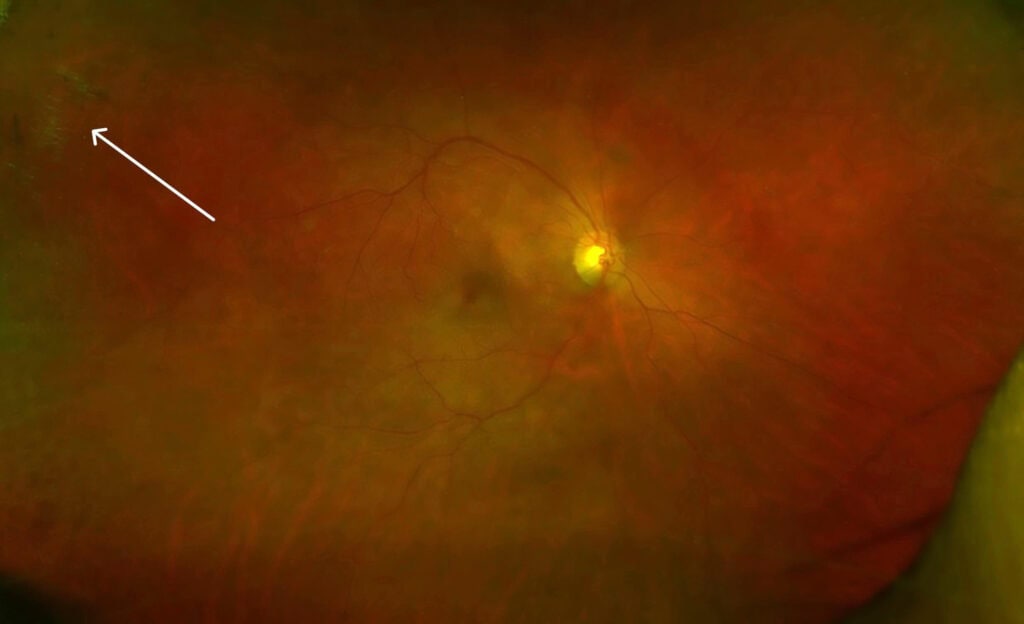 myotonic dystrophy figure 4 edit (1)