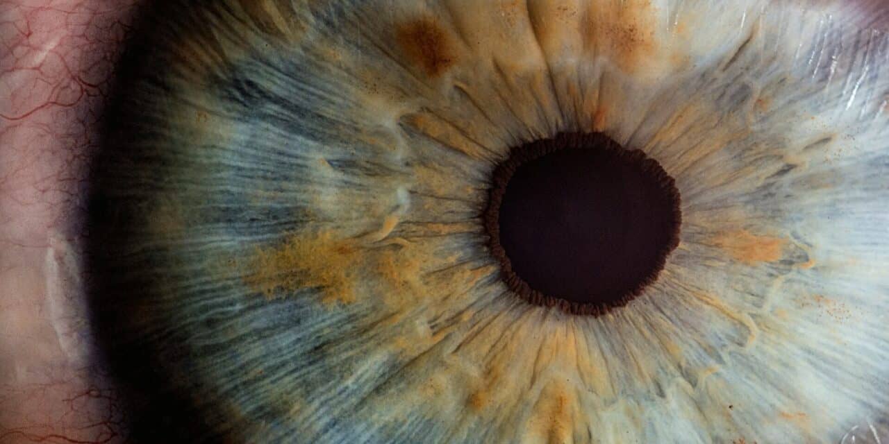 A Rare Case of Recurrence of Bilateral Corneal Edema Secondary to Amantadine