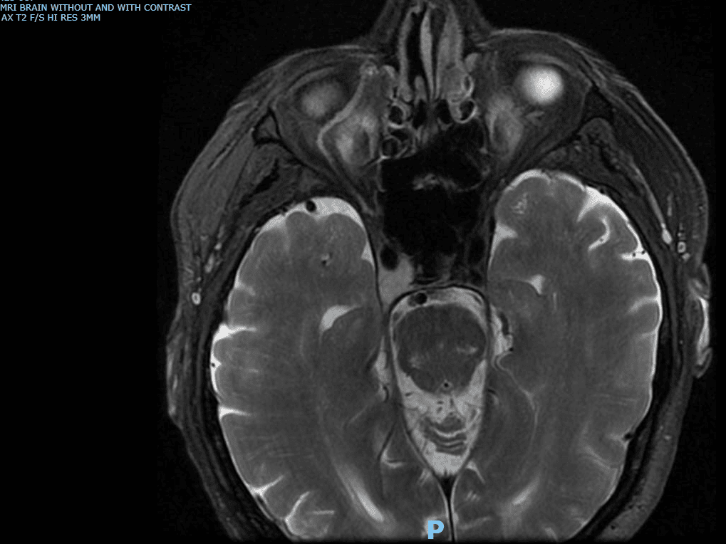 fig 3 mri brain axial t2 hi res 3 mm(1) (medium)
