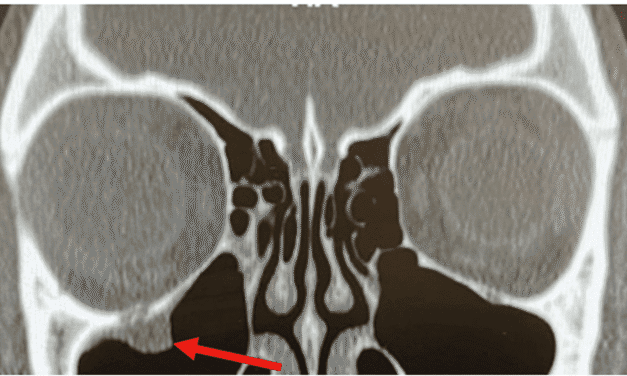 The “Not So Easy” Orbital Floor Fracture Case