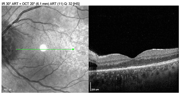 Bilateral Optic Nerve Edema Leading to the Diagnosis of Ocular Syphilis