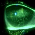 Ocular Sequelae of Trigeminal Neuralgia Following Complicated Oral Surgery: A Case Report