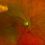 Photo Essay: Sclerochoroidal Calcifications