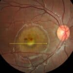 Case Report: Genetically Confirmed Best Vitelliform Macular Dystrophy and Butterfly Pattern Dystrophy in the Same Family