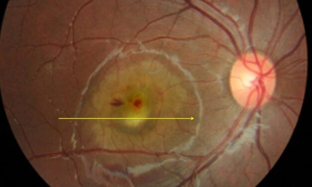Case Report: Genetically Confirmed Best Vitelliform Macular Dystrophy and Butterfly Pattern Dystrophy in the Same Family