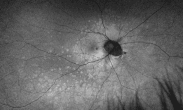 A Case of Multiple Evanescent White Dot Syndrome in a Myopic Male