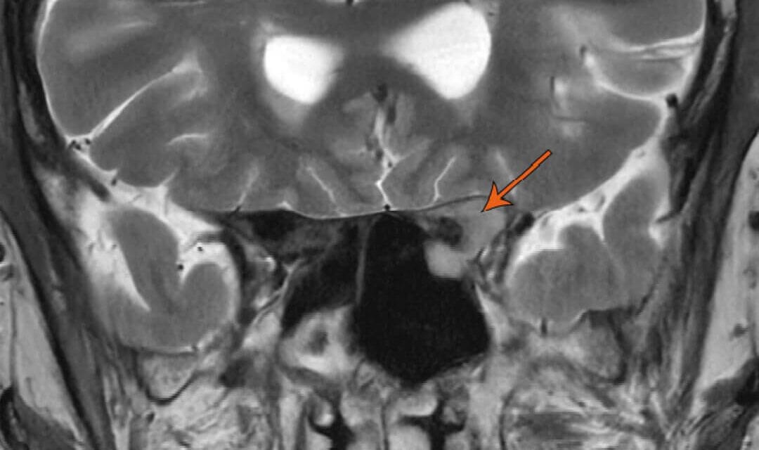 When Prostate Cancer Reaches the Orbit: A Case Report