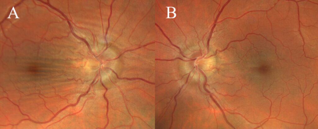 fig 1 disc edema baseline (large) (1)