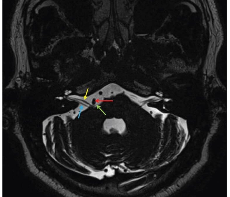 A Multidisciplinary Approach in the Management of Hemifacial Spasm
