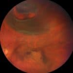 Photo Essay and A Brief Report on New Rhegmatogenous Retinal Detachment Management