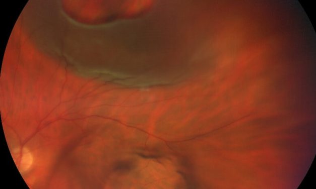 Photo Essay and A Brief Report on New Rhegmatogenous Retinal Detachment Management
