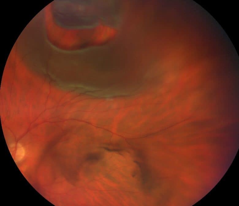 Photo Essay and A Brief Report on New Rhegmatogenous Retinal Detachment Management