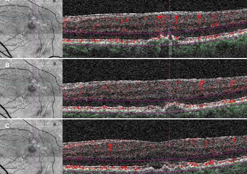 Subjective Dyschromatopsia as presenting symptom of Neovascular Age-Related Macular Degeneration