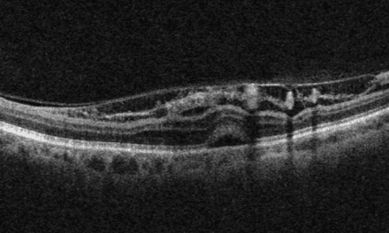 Peripapillary Retinoschisis in a Patient with Severe Primary Open Angle Glaucoma