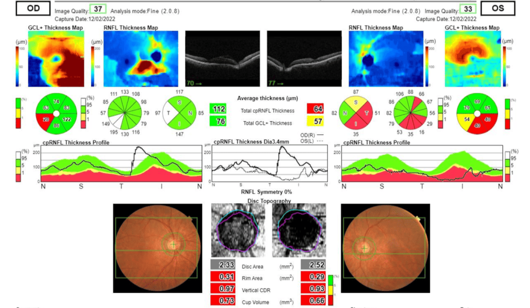 Ovft Optometry Case Report: Peripapillary Retinoschisis in a patient with Severe ...