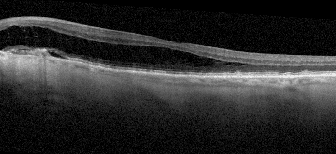 Lessons on Juxtapapillary Fluid