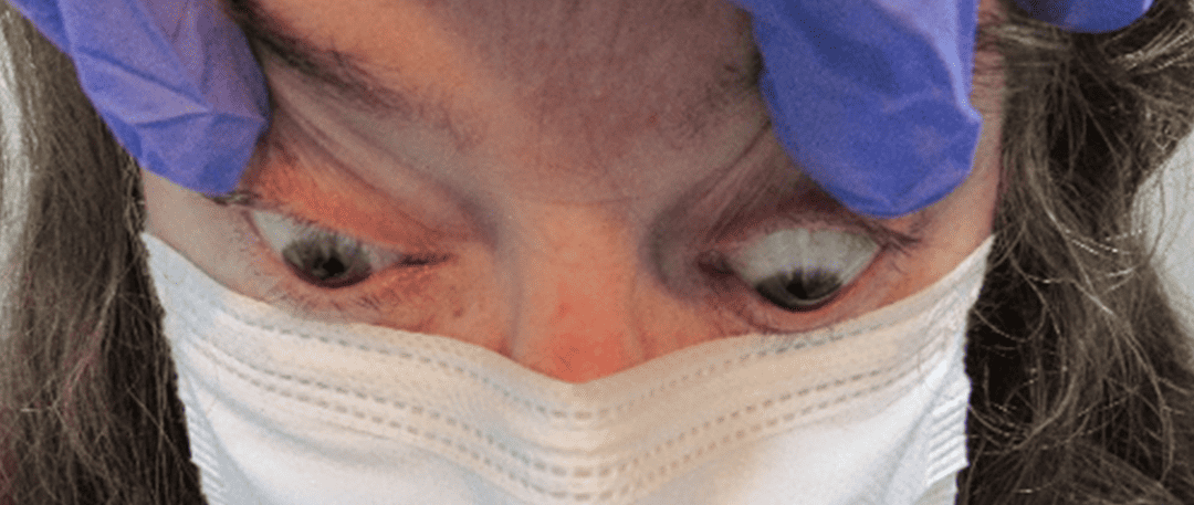 An optometrically driven approach: diagnosing a patient with active thyroid eye disease in the setting of Hashimoto’s thyroiditis