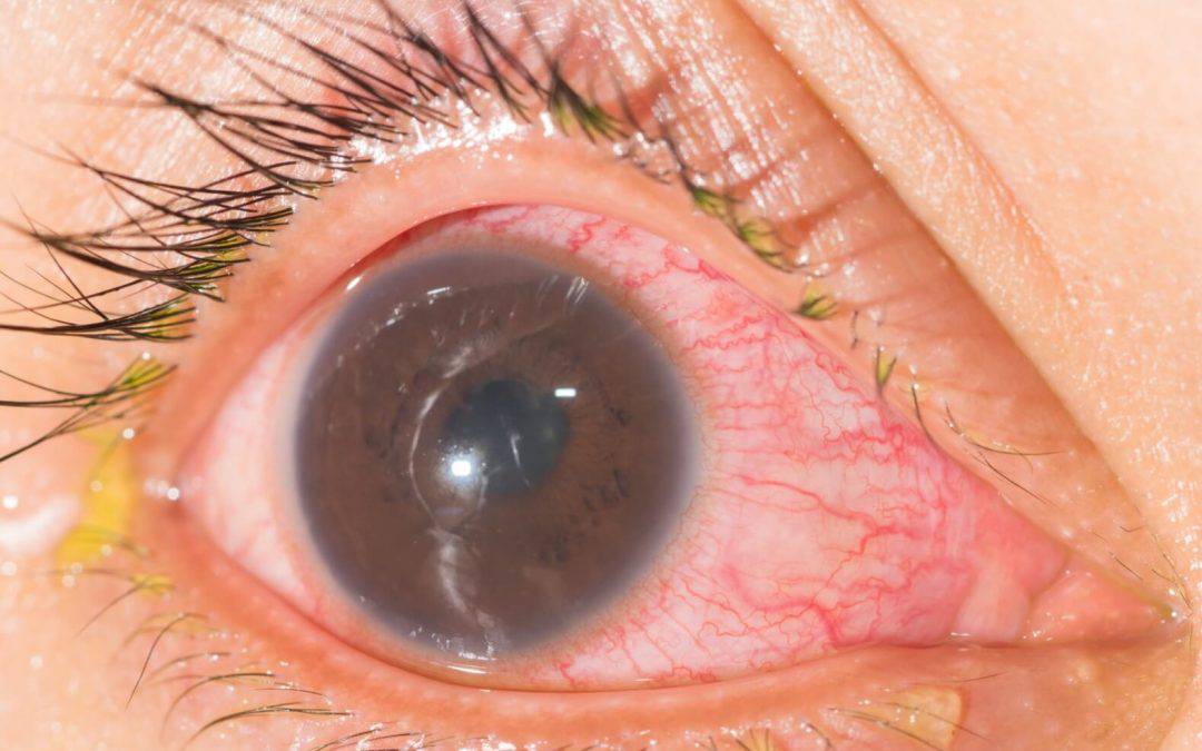 Uveitis: Laboratory Investigations and Current Recommendations on Diagnosis