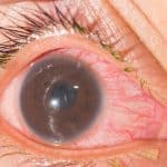 Uveitis: Laboratory Investigations and Current Recommendations on Diagnosis