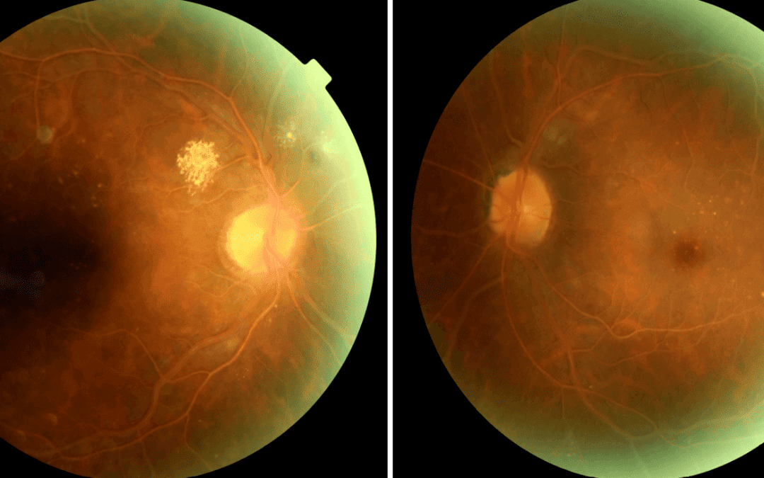 Retinopathy Prompting Laboratory Testing: a report of two cases