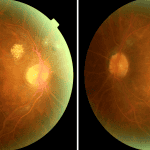 Retinopathy Prompting Laboratory Testing: a report of two cases