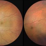Sickle cell retinopathy: diagnosis, management, and treatment