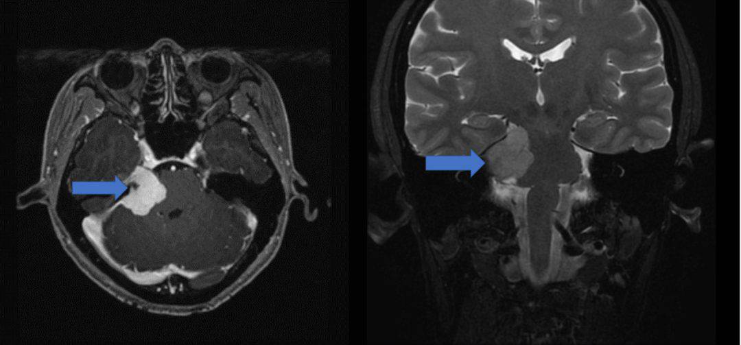 A Surprise Diagnosis from a Unilateral Hearing Loss and Vertigo Case ...