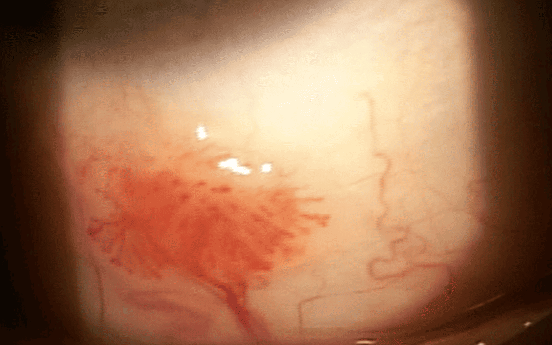Recurrent Conjunctival Squamous Papilloma
