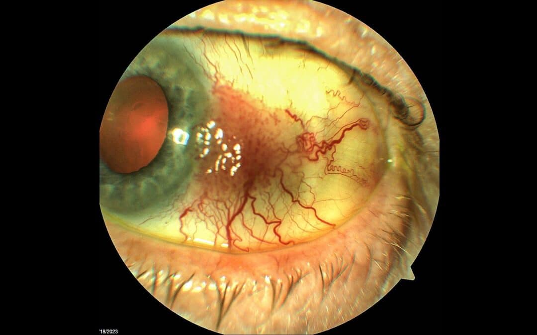 PHOTO ESSAY: “New” Red Eye – A Case of Conjunctival Intraepithelial Neoplasia